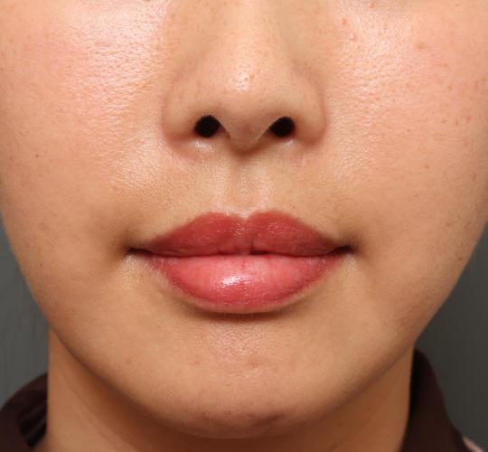 30代女性の耳介軟骨移植 Before 症例写真