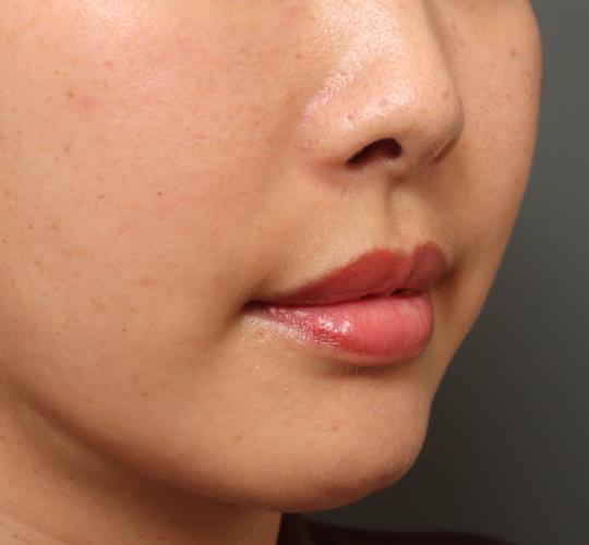 30代女性の耳介軟骨移植 Before 症例写真