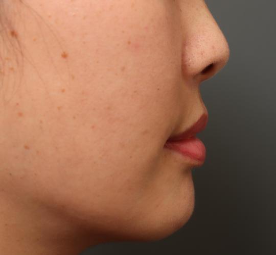 30代女性の耳介軟骨移植 Before 症例写真