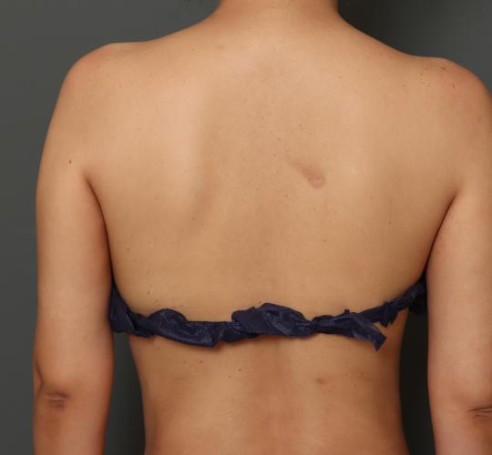 30代女性の脂肪吸引 After 症例写真