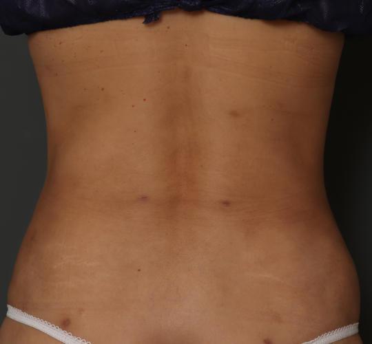 30代女性の脂肪吸引 After 症例写真
