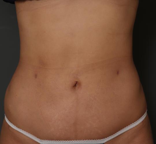 30代女性の脂肪吸引 After 症例写真