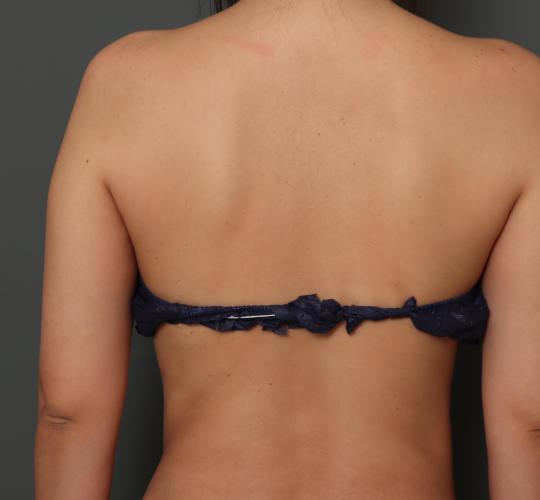 30代女性の脂肪吸引 Before 症例写真