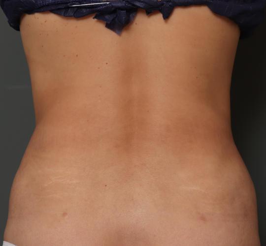 30代女性の脂肪吸引 Before 症例写真