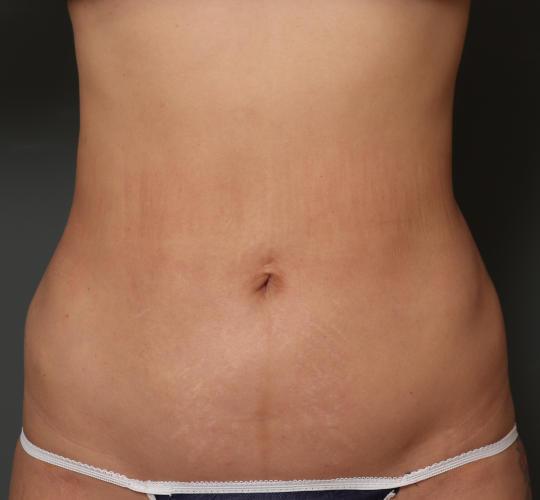 30代女性の脂肪吸引 Before 症例写真