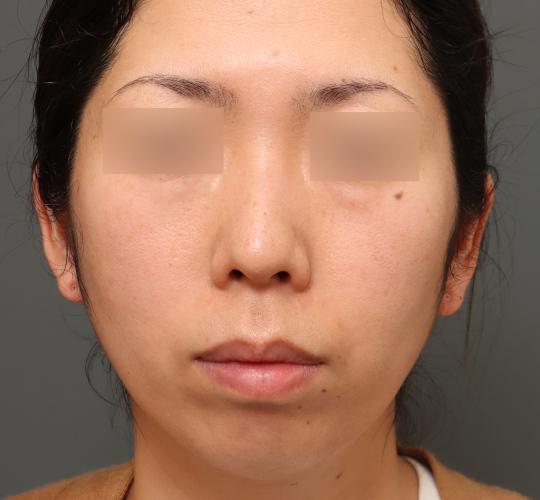 30代女性のレチノールダーマペン After 症例写真