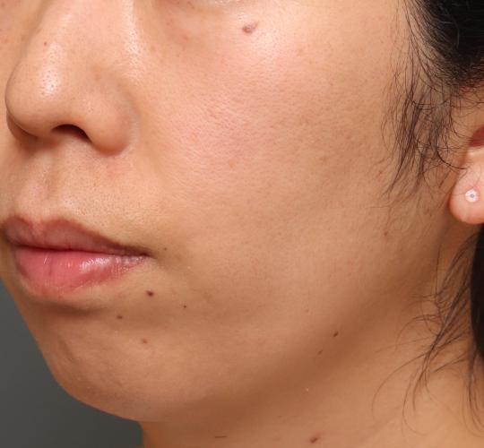 30代女性のレチノールダーマペン After 症例写真