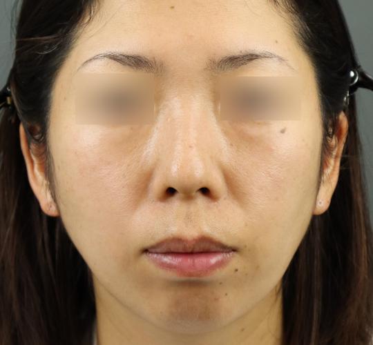 30代女性のレチノールダーマペン Before 症例写真