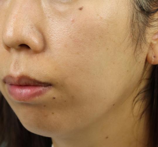 30代女性のレチノールダーマペン Before 症例写真