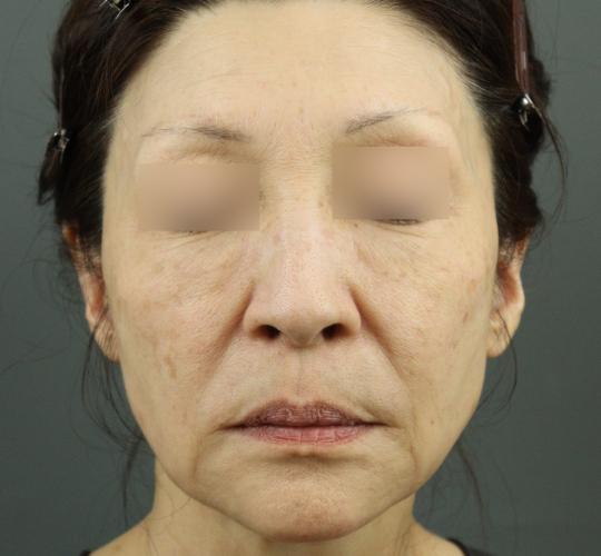 60代女性のシワ・たるみ After 症例写真