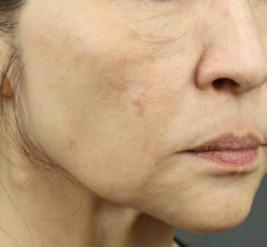 60代女性のスネコス After 症例写真