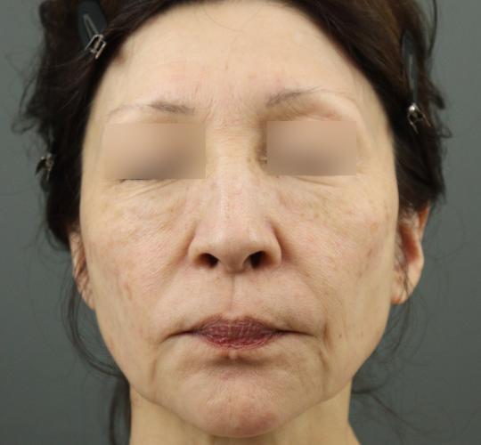 60代女性のシワ・たるみ Before 症例写真