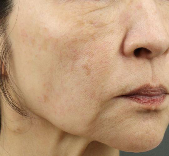 60代女性のスネコス Before 症例写真