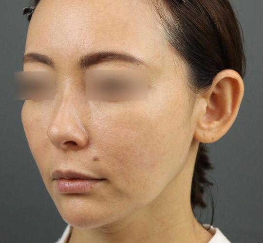 40代女性のヒアルロン酸骨格リフト After 症例写真