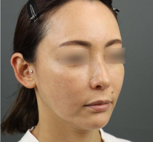 40代女性のヒアルロン酸骨格リフト After 症例写真