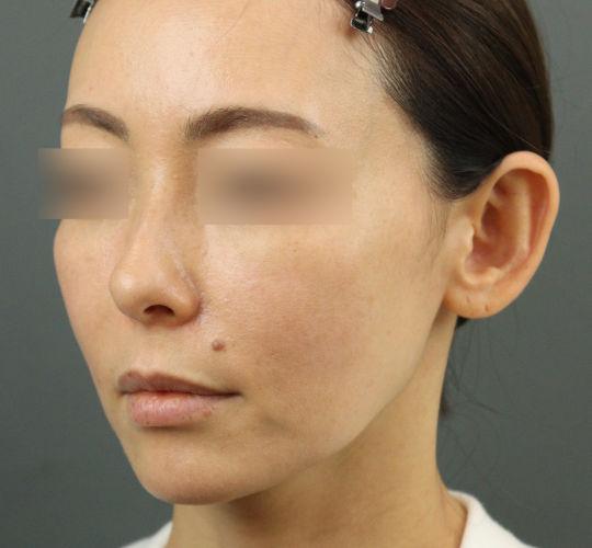 40代女性のヒアルロン酸骨格リフト Before 症例写真