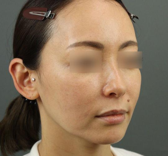 40代女性のヒアルロン酸骨格リフト Before 症例写真