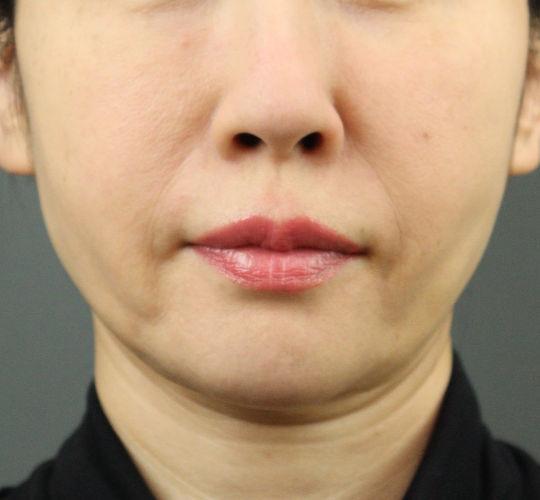 50代女性のエラ・アゴ・小顔 After 症例写真