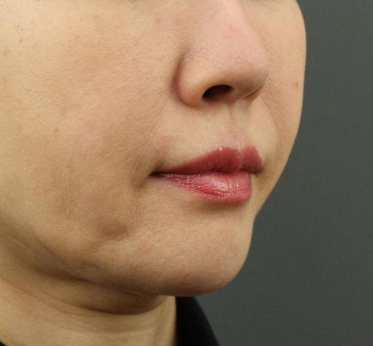 50代女性のヒアルロン酸注射（ほうれい線） After 症例写真