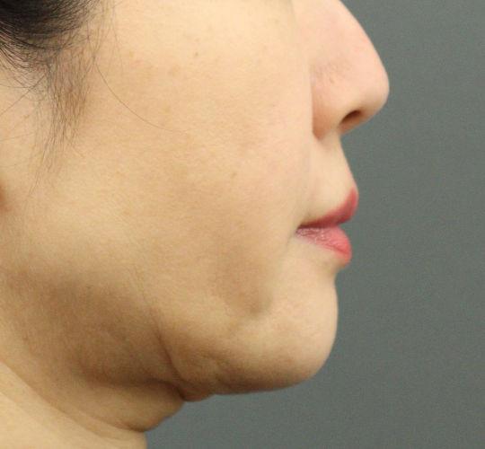 50代女性のヒアルロン酸注射（ほうれい線） After 症例写真