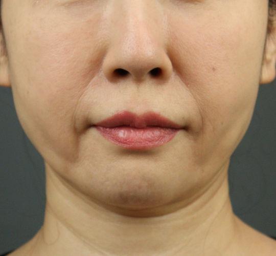 50代女性のエラ・アゴ・小顔 Before 症例写真