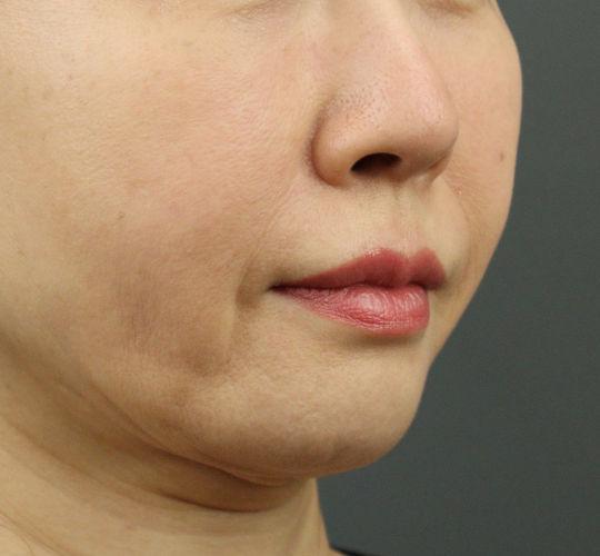 50代女性のヒアルロン酸注射（ほうれい線） Before 症例写真