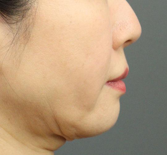 50代女性のヒアルロン酸注射（ほうれい線） Before 症例写真