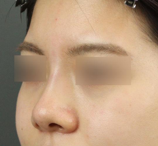 20代女性のヒアルロン酸注射（鼻形成） After 症例写真