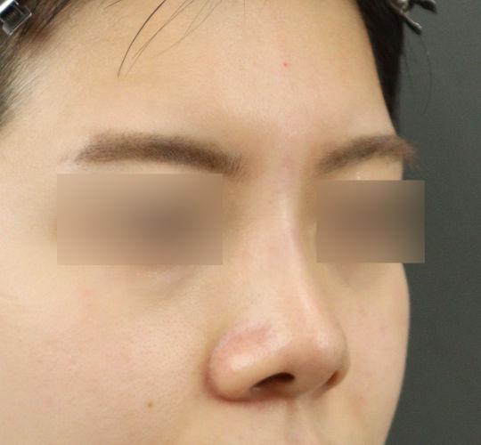 20代女性のヒアルロン酸注射（鼻形成） After 症例写真