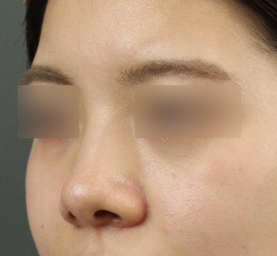 20代女性のヒアルロン酸注射（鼻形成） Before 症例写真