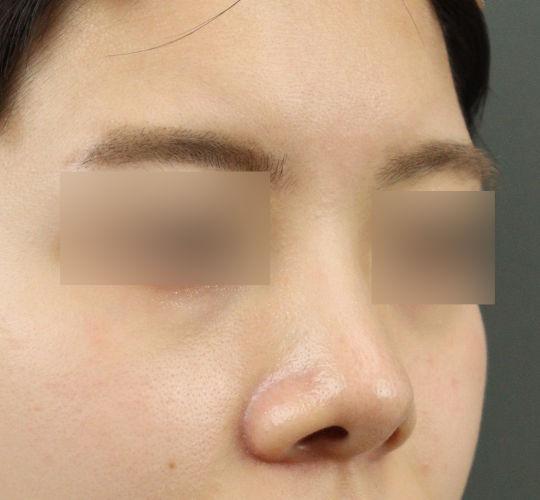 20代女性のヒアルロン酸注射（鼻形成） Before 症例写真