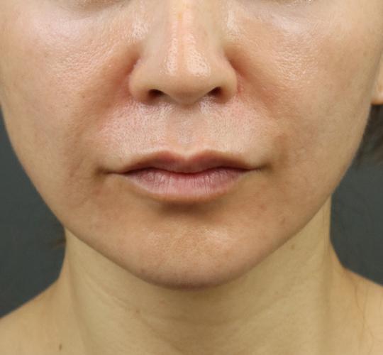 50代女性のヒアルロン酸注射（ほうれい線） After 症例写真