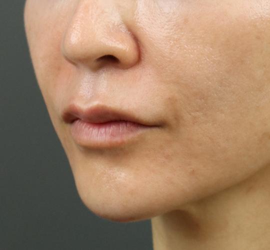 50代女性のヒアルロン酸注射（ほうれい線） After 症例写真