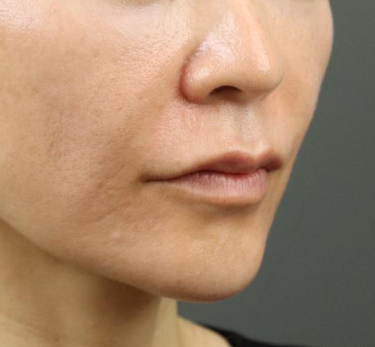 50代女性のヒアルロン酸注射（ほうれい線） After 症例写真