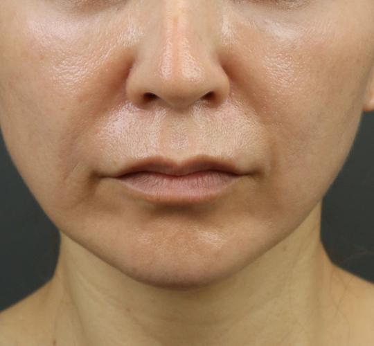 50代女性のヒアルロン酸注射（ほうれい線） Before 症例写真