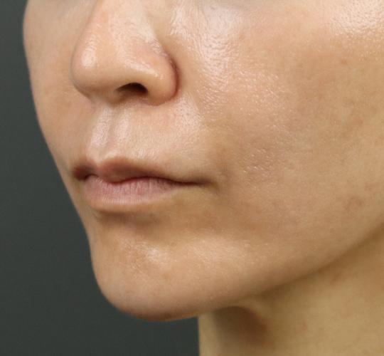 50代女性のヒアルロン酸注射（ほうれい線） Before 症例写真