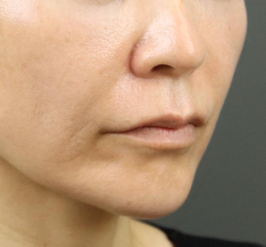 50代女性のヒアルロン酸注射（ほうれい線） Before 症例写真