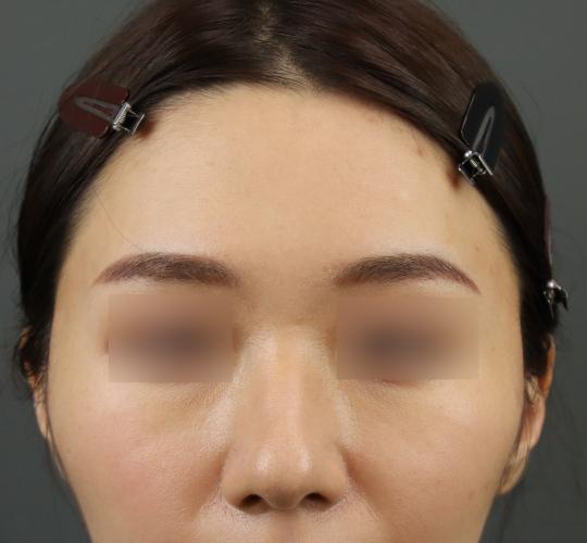 20代女性のシワ・たるみ After 症例写真