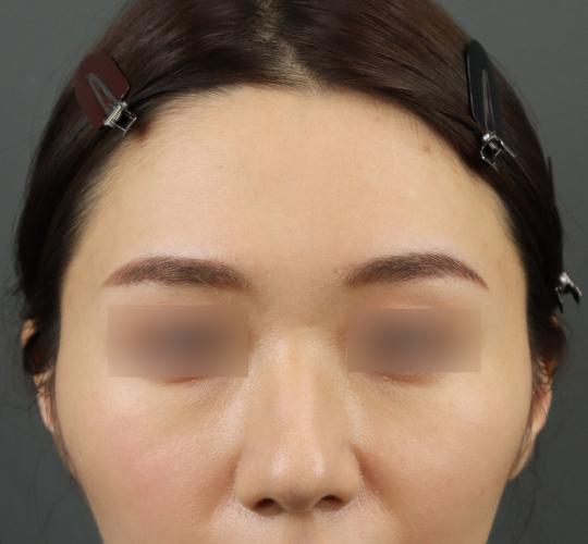 20代女性のシワ・たるみ Before 症例写真