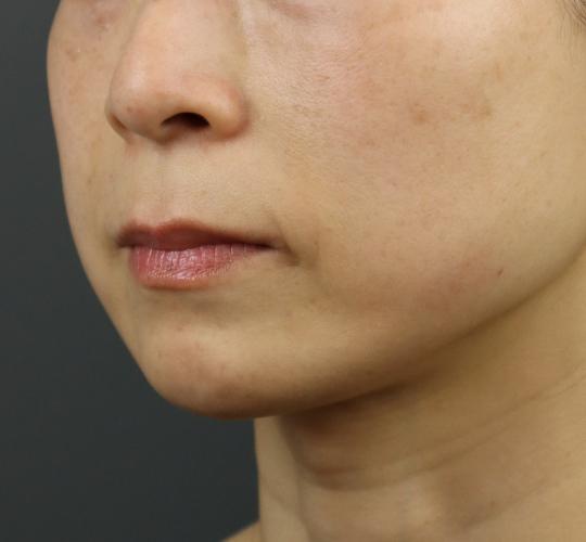 40代女性のヒアルロン酸注射（アゴ形成） After 症例写真