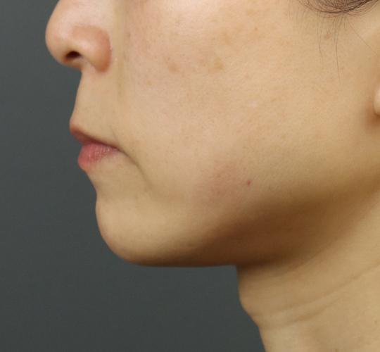 40代女性のヒアルロン酸注射（アゴ形成） After 症例写真