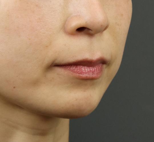 40代女性のヒアルロン酸注射（アゴ形成） After 症例写真