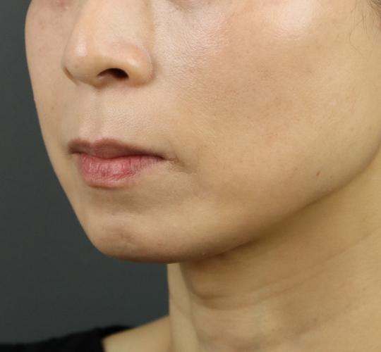 40代女性のヒアルロン酸注射（アゴ形成） Before 症例写真