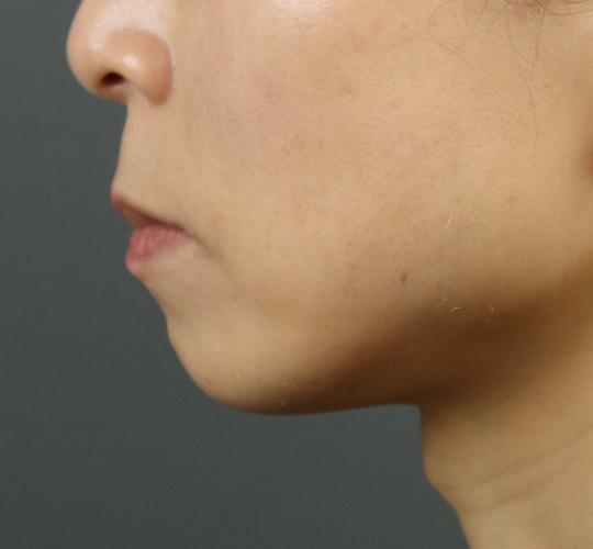 40代女性のヒアルロン酸注射（アゴ形成） Before 症例写真