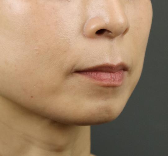 40代女性のヒアルロン酸注射（アゴ形成） Before 症例写真