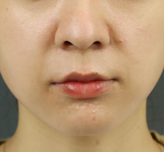 30代女性の人中短縮ボトックス After 症例写真