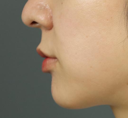 30代女性の人中短縮ボトックス After 症例写真