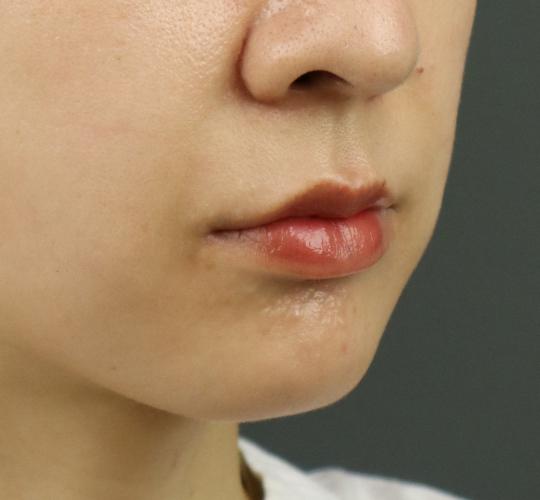 30代女性の人中短縮ボトックス After 症例写真