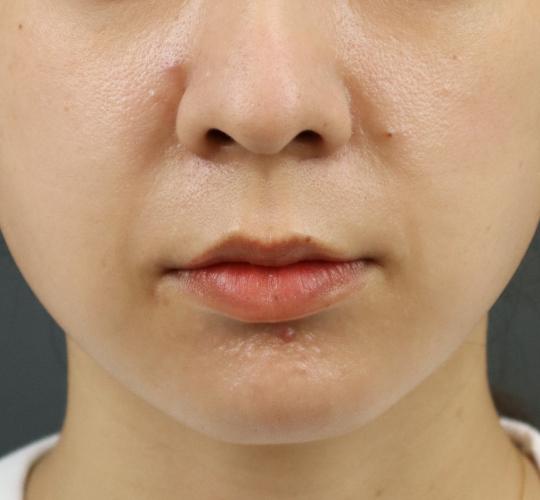 30代女性の人中短縮ボトックス Before 症例写真