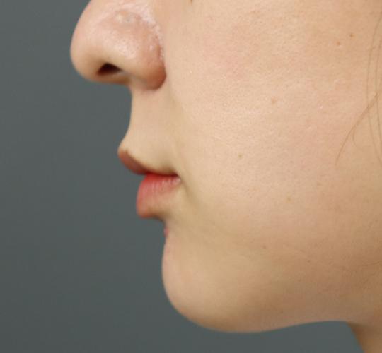 30代女性の人中短縮ボトックス Before 症例写真